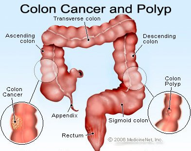 colon cancer and polyp.jpg