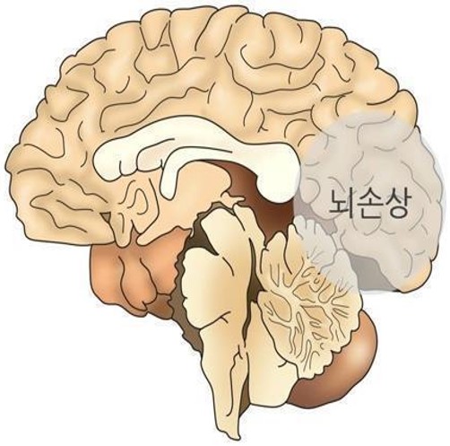 뇌진탕 후 뇌에 철분 증가한다.jpg
