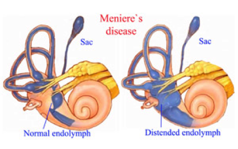Meniere's Disease.png