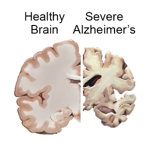 알츠하이머병, 뇌 속 ‘철분 산화·환원’의 증가 때문에 발생할 수도 있다.jpg