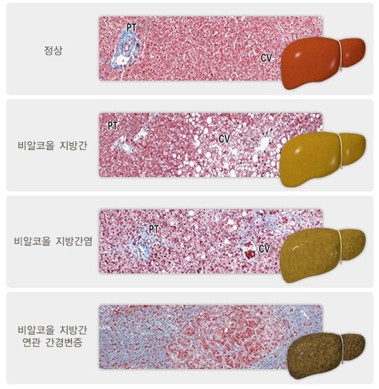 비(非)알코올 지방간의 진행 모습.jpg