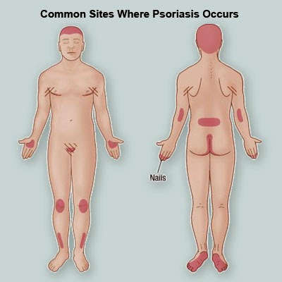psoriasis-skin-on-body.jpg