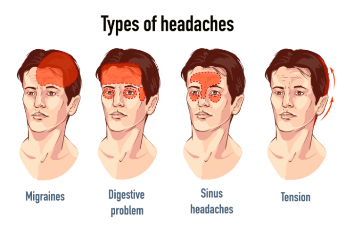 Types of headache.png